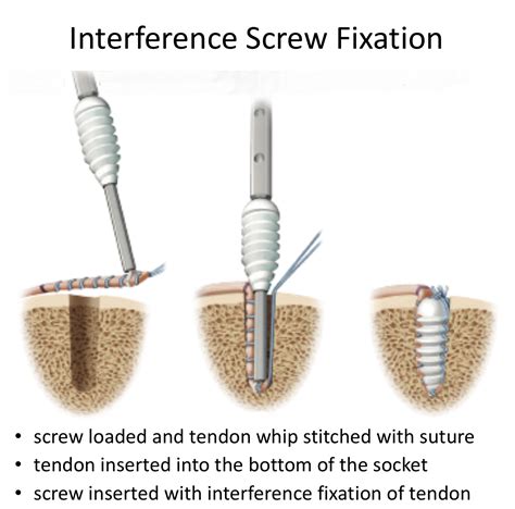 interference.screw torsional testing|The Principles of Interference Screw Fixation: Application to.